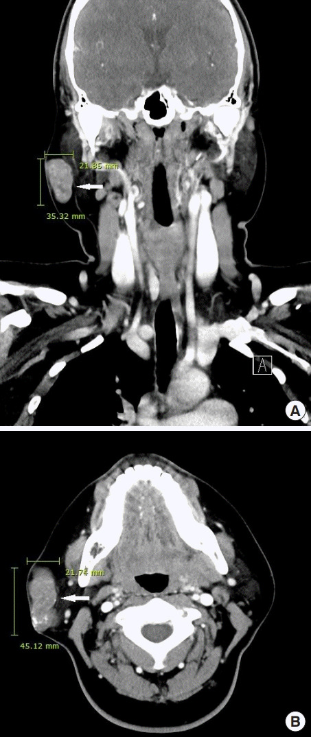【佳学基因检测】巨大毛母质瘤的基因检测案例 【佳学基因检测】巨大毛母质瘤的基因检测案例