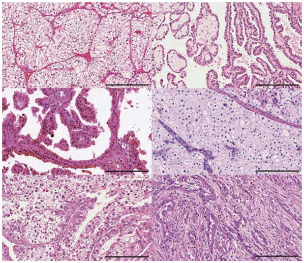【佳学基因检测】肾细胞癌的分子诊断及分类