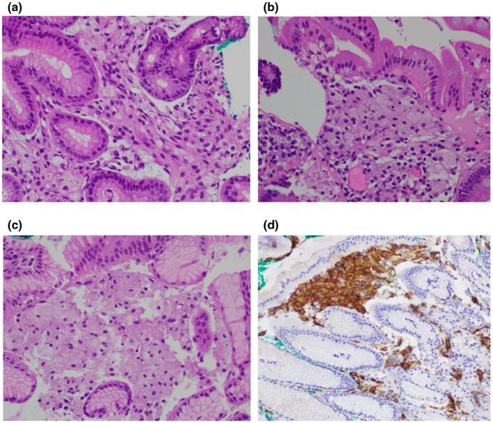 【佳学基因检测】CHILD综合征基因解码、基因检测有什么用？