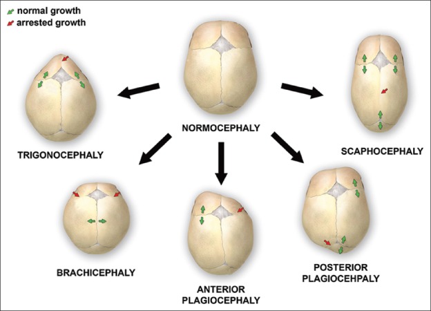 【佳学基因检测】囟门或颅缝异常基因检测 Abnormality of the fontanelles or cranial sutures 【佳学基因检测】囟门或颅缝异常基因检测 Abnormality of the fontanelles or cranial sutures