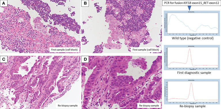 【佳学基因检测】肺癌靶向药物基因检测为什么要包含RET重排 【佳学基因检测】肺癌靶向药物基因检测为什么要包含RET重排