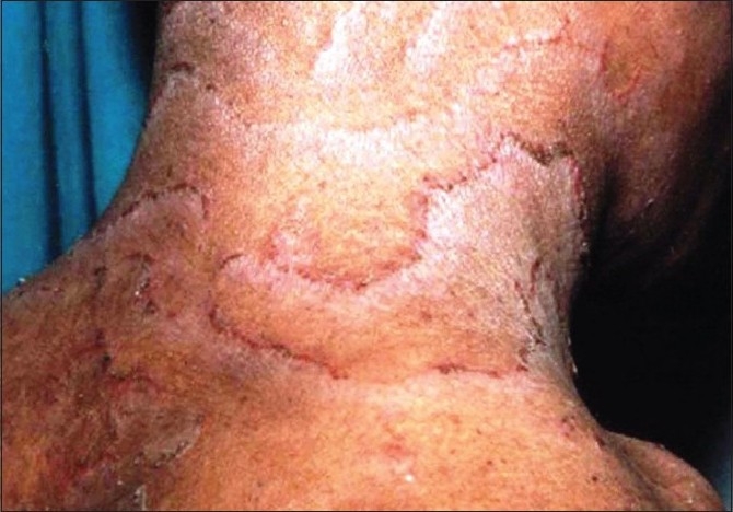 【佳学基因检测】竹节状头发综合征基因检测Bamboo hair syndrome 【佳学基因检测】竹节状头发综合征基因检测Bamboo hair syndrome