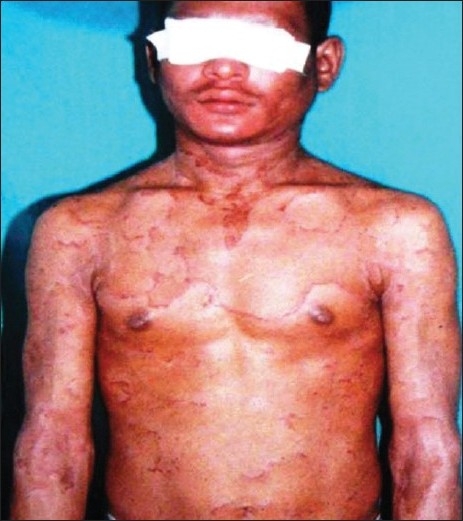 【佳学基因检测】竹节状头发综合征基因检测Bamboo hair syndrome