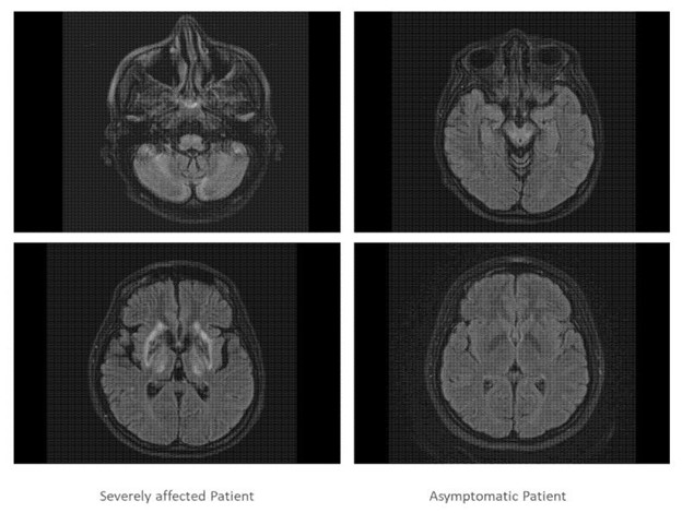 【佳学基因检测】基因检测纯合子双胞胎的临床表型变异性及对治疗法方案的差异性 【佳学基因检测】基因检测纯合子双胞胎的临床表型变异性及对治疗法方案的差异性