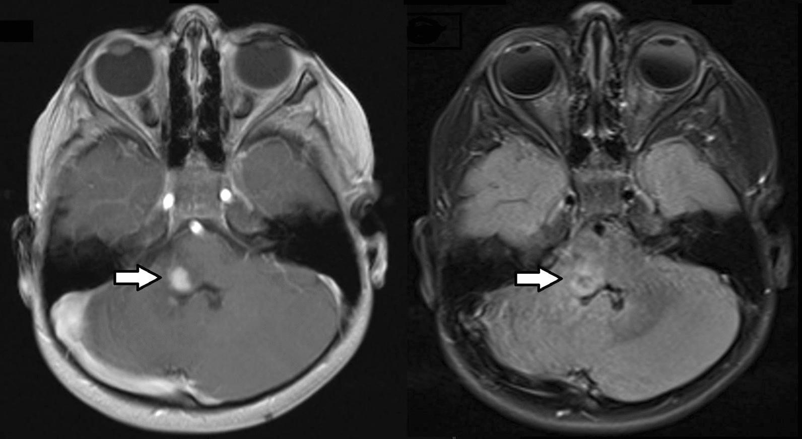 【佳学基因检测】脑干神经瘤NF2基因检测结果阴性是怎么找到致病基因突变的? 【佳学基因检测】脑干神经瘤NF2基因检测结果阴性是怎么找到致病基因突变的?