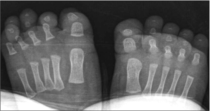 【佳学基因检测】先天性第四脚趾趾甲的弯曲基因检测