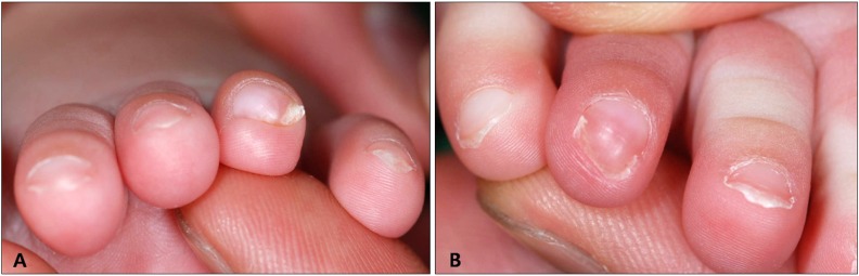 【佳学基因检测】先天性第四脚趾趾甲的弯曲基因检测