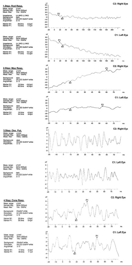【佳学基因检测】巨额花费肾移植,却得了视网膜纤毛病:基因检测在肾病与眼科共病中的作用 【佳学基因检测】巨额花费肾移植,却得了视网膜纤毛病:基因检测在肾病与眼科共病中的作用