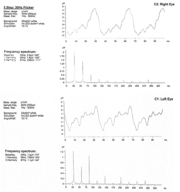 【佳学基因检测】巨额花费肾移植,却得了视网膜纤毛病:基因检测在肾病与眼科共病中的作用 【佳学基因检测】巨额花费肾移植,却得了视网膜纤毛病:基因检测在肾病与眼科共病中的作用